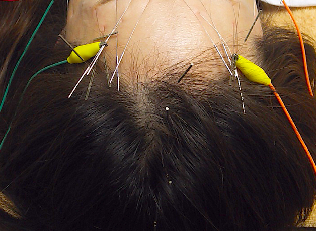 頭皮にも刺すことで、自律神経の乱れを整えることができるから